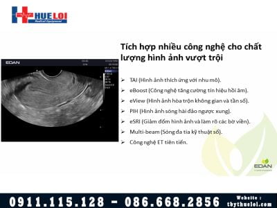 Máy Siêu Âm 4D EDAN AX3 - Công Nghệ Vượt Tầm Phân Khúc 