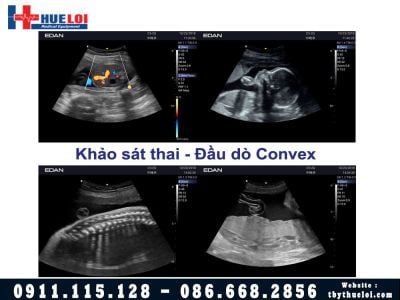 Máy Siêu Âm 4D EDAN AX3 - Công Nghệ Vượt Tầm Phân Khúc 