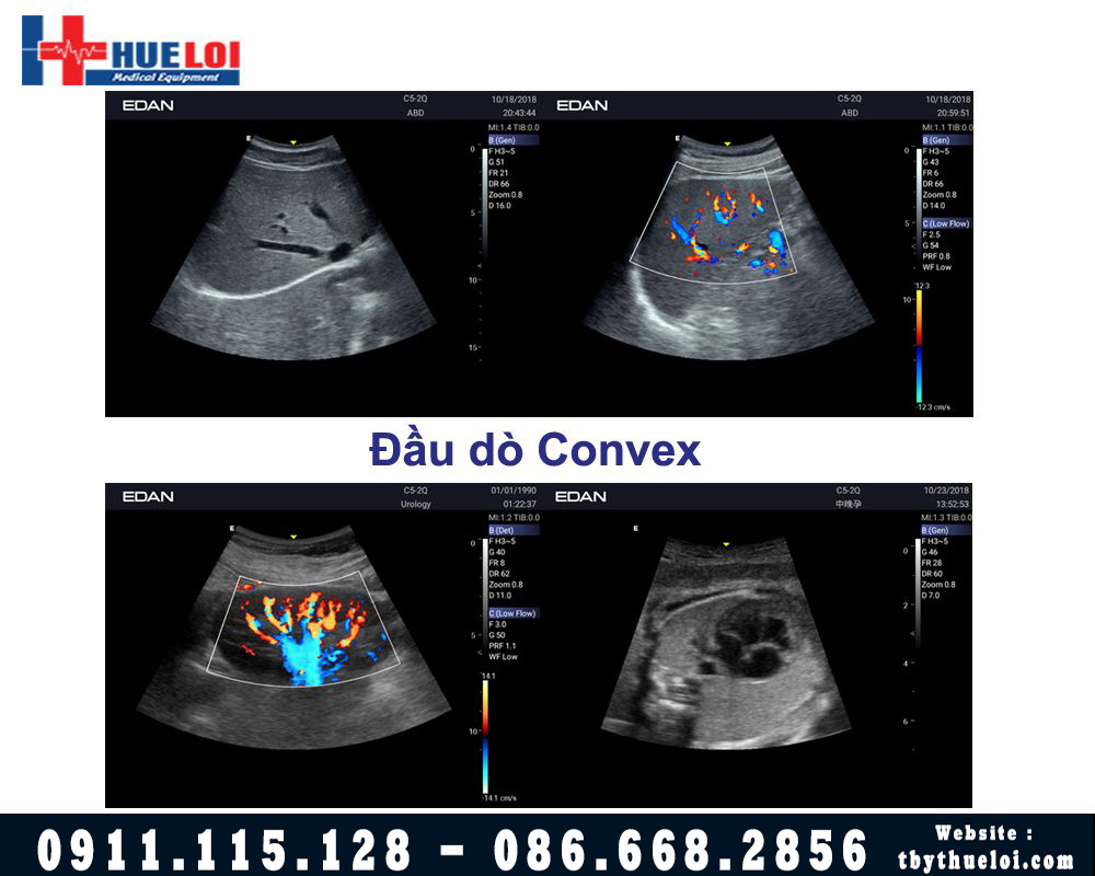 hình ảnh đầu dò convex ax3