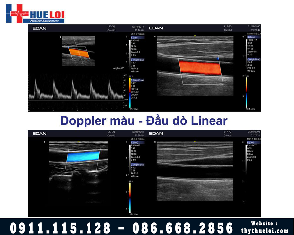 Hình ảnh doppler màu đầu dò linner máy siêu âm AX3