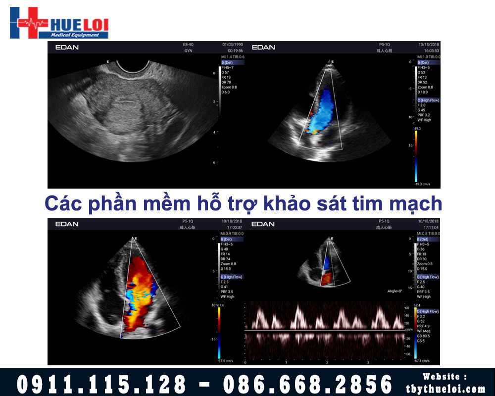 hình ảnh siêu âm tim EDAN AX3